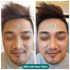 HIKO with Nose Fillers (1)