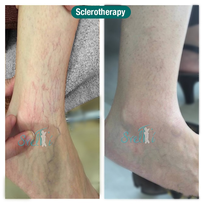 SCLEROtherapy